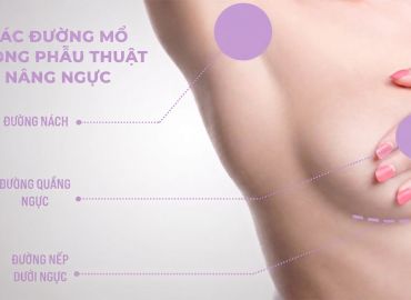 N&ecirc;n N&acirc;ng Ngực Đường N&agrave;o? C&aacute;c Đường N&acirc;ng Ngực Cần Biết Trước Khi L&agrave;m