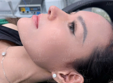 N&acirc;ng Mũi Tự Nhi&ecirc;n Cho Người Mới: Kinh Nghiệm V&agrave; Lộ Tr&igrave;nh Hồi Phục