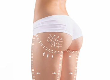 N&acirc;ng m&ocirc;ng bằng mỡ tự th&acirc;n giữ được bao l&acirc;u? [Giải đ&aacute;p 2024]