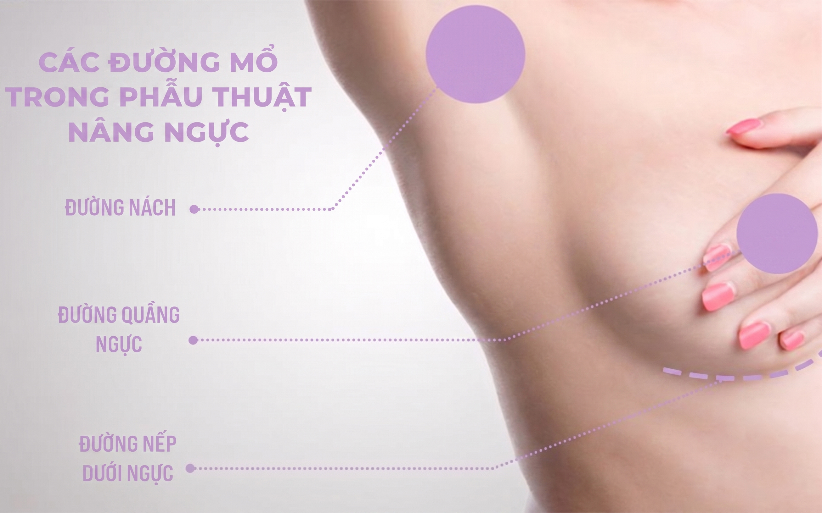 N&ecirc;n N&acirc;ng Ngực Đường N&agrave;o? C&aacute;c Đường N&acirc;ng Ngực Cần Biết Trước Khi L&agrave;m