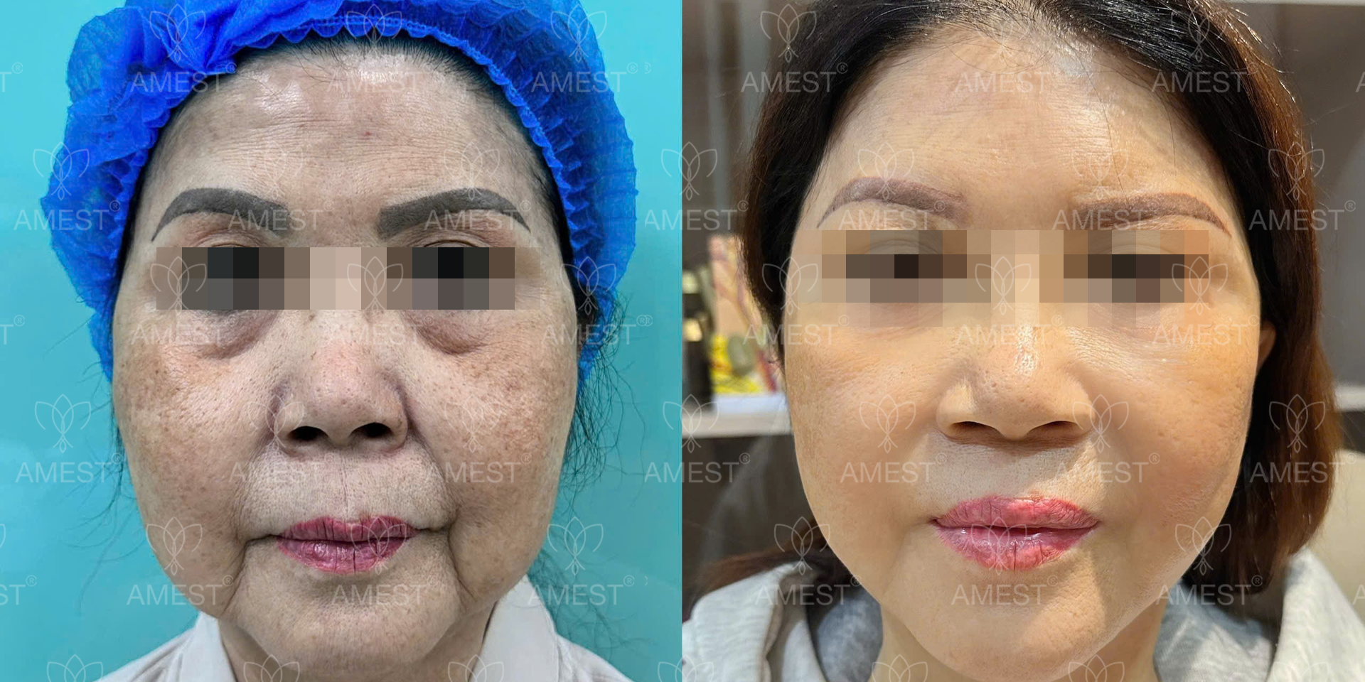 Trẻ H&oacute;a Da Mặt To&agrave;n Diện: Sự Thật Về Căng Da Mặt To&agrave;n Phần & Midface