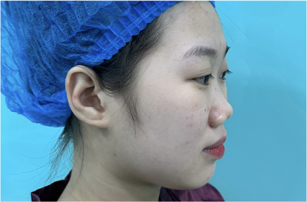 <img src=" Mũi-thấp-tẹt-l&agrave;-g&igrave;-?.jpg " alt="Mũi thấp tẹt l&agrave; g&igrave;?" />