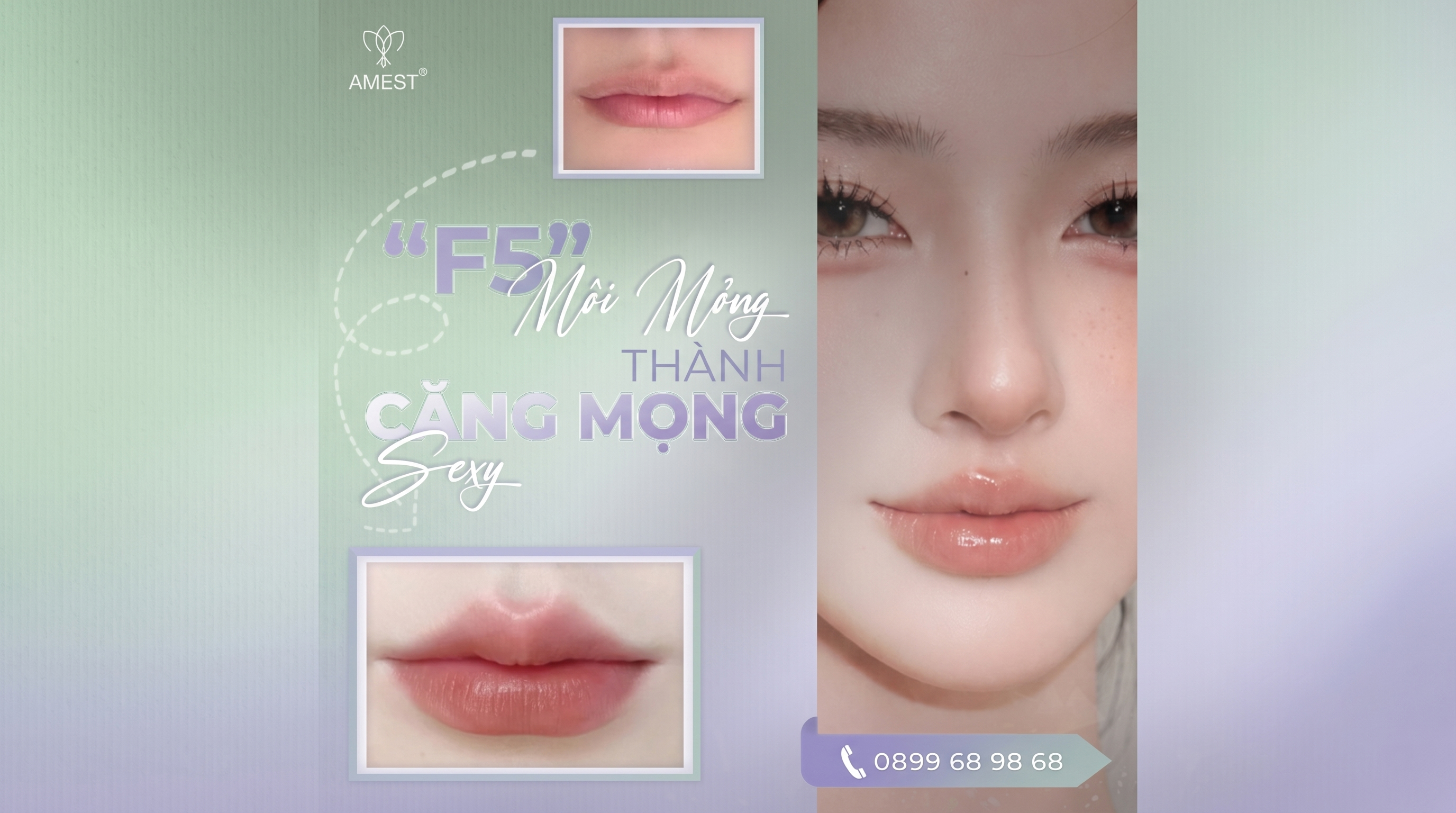 Xu Hướng Ti&ecirc;m Filler M&ocirc;i 2026: D&aacute;ng M&ocirc;i Tự Nhi&ecirc;n, Mọng Nước