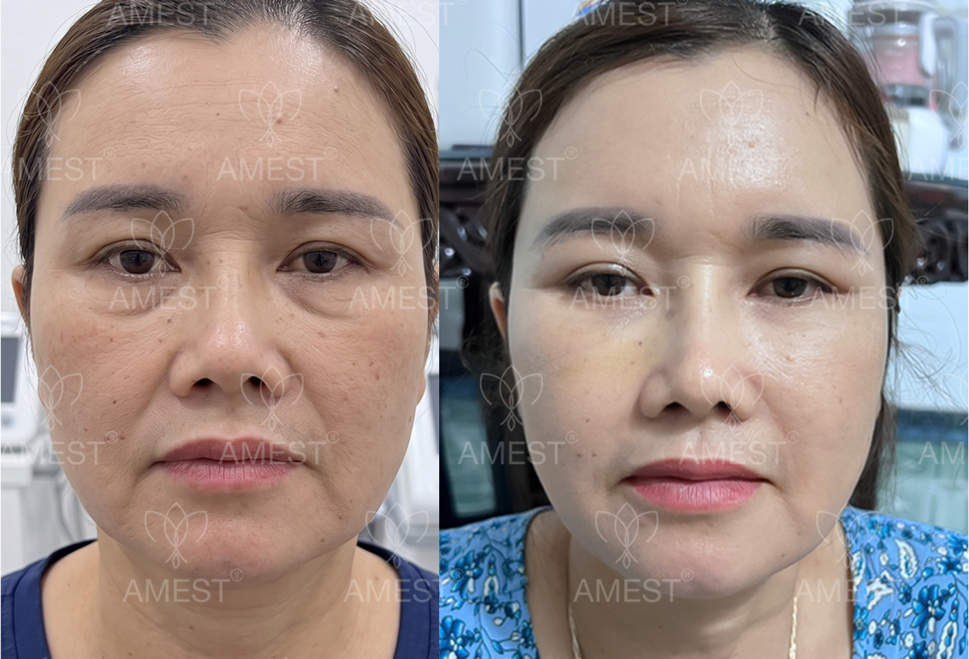 Đ&acirc;u L&agrave; Phương Ph&aacute;p Căng Da Mặt Tốt Nhất Hiện Nay? Ưu Điểm Vượt Trội Của Midface