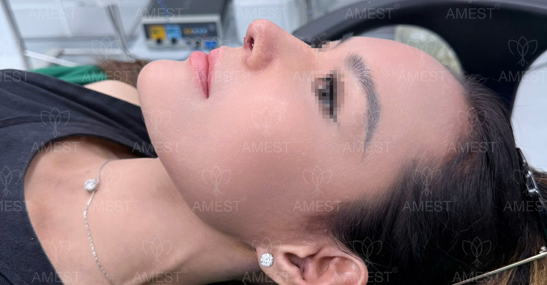 N&acirc;ng Mũi Tự Nhi&ecirc;n Cho Người Mới: Kinh Nghiệm V&agrave; Lộ Tr&igrave;nh Hồi Phục