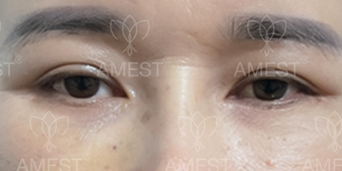 <img src="khong-de-lai-seo-sau-phauu-thuat-midface.jpg " alt="khong de lai seo sau phau thuat midface" />