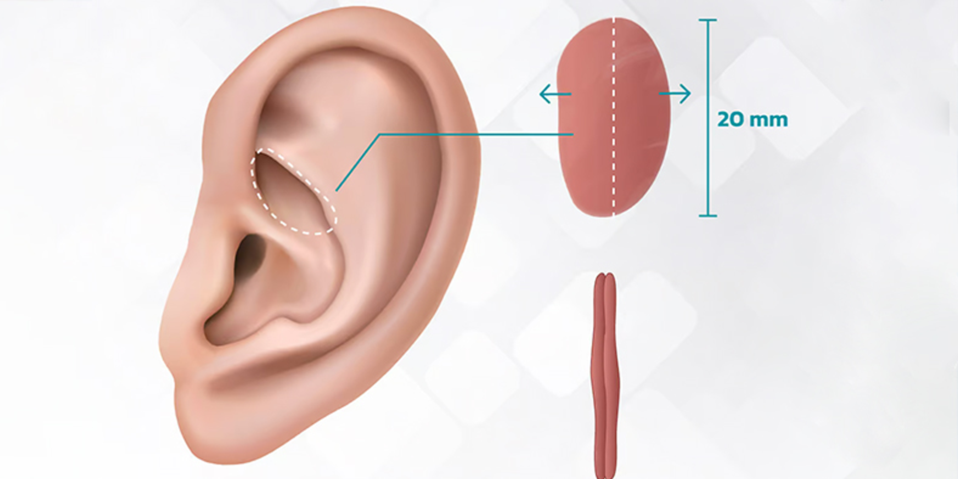 C&aacute;c Phương Ph&aacute;p N&acirc;ng Mũi Phổ Biến Hiện Nay: N&ecirc;n Chọn Kỹ Thuật N&agrave;o?