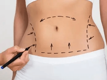 C&oacute; n&ecirc;n đi h&uacute;t mỡ bụng kh&ocirc;ng?